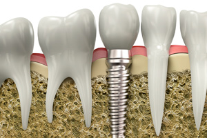 Dental Implants